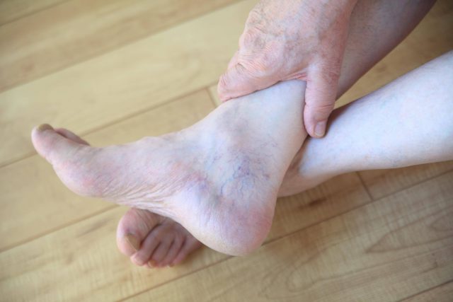 Expanding Feet, C. Difficile and Varicose Veins
