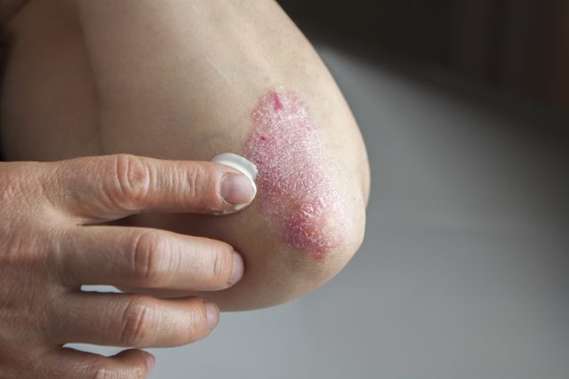 Is There a Cure for Psoriasis?