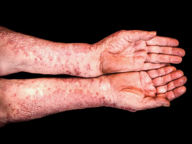 Measles, Mumps and Chicken Pox