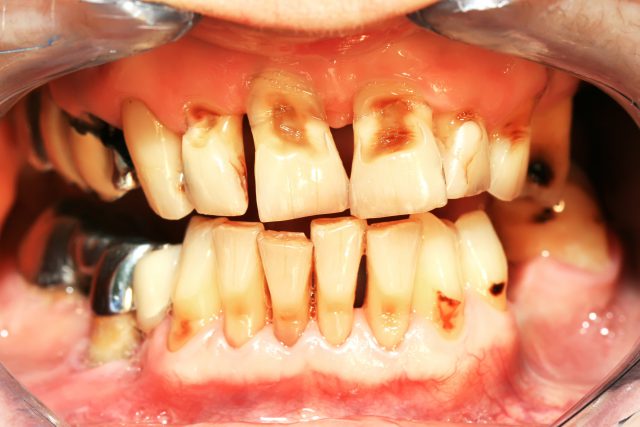 Tooth Decay, Poison and Headaches