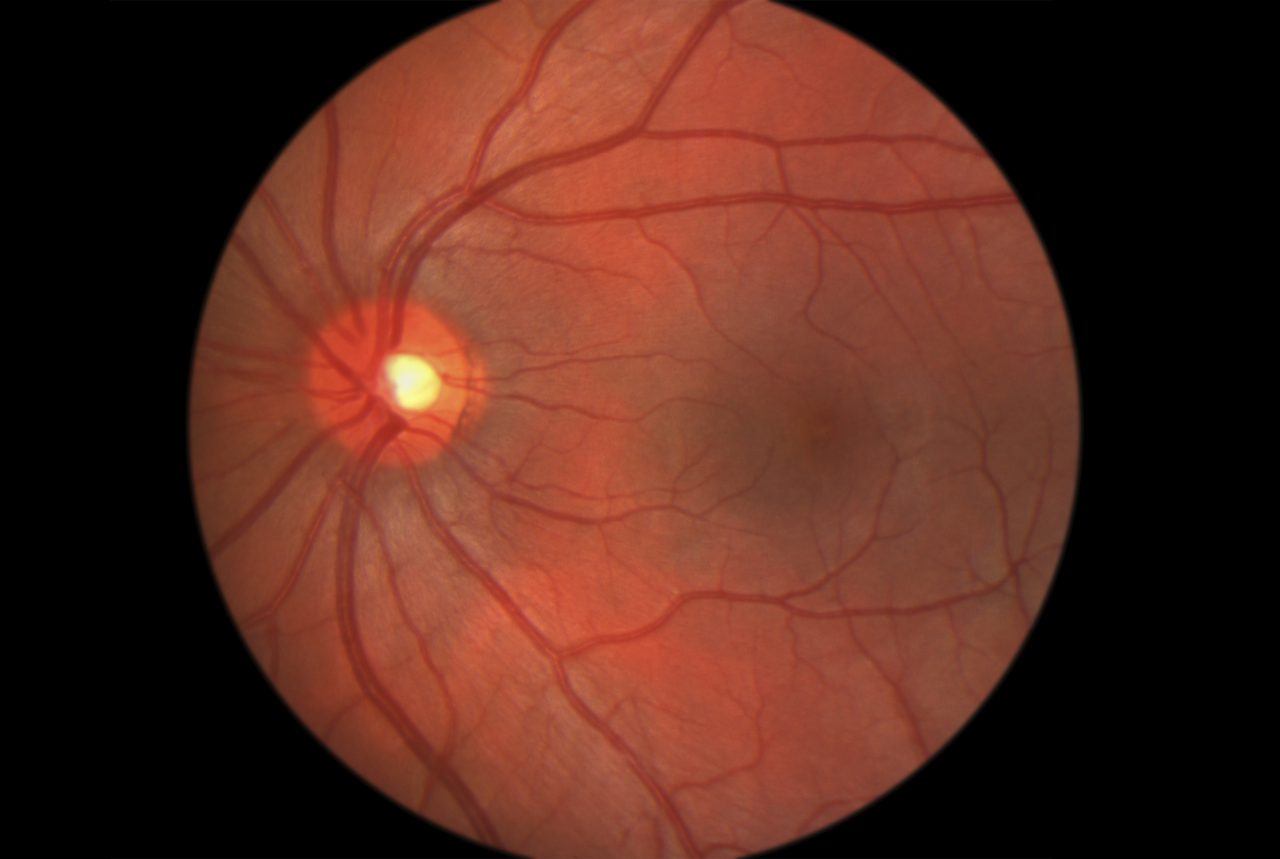 Macular Degeneration, NSAIDs, and Hip Replacements
